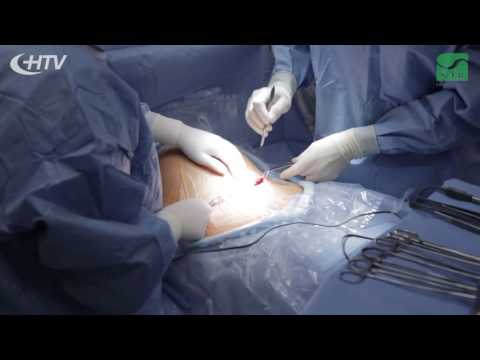 Video: Jak Probíhá Operace Císařským řezem