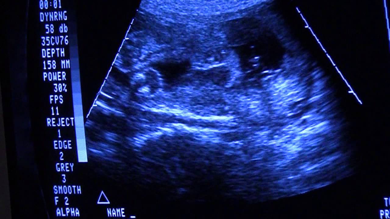 Pregnancy Ultrasound - Baby at 24 weeks pregnant * Gender - YouTube