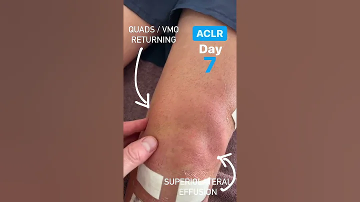 New ACL surgery patient in this week. Here is his quads activation at day 7 post-op.