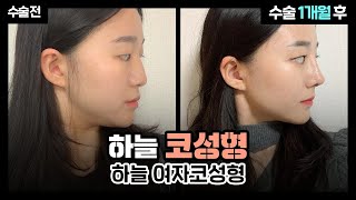 [부산코성형/부산코수술] 복코+매부리 BYE,,? 나는 이제 다시 태어났다굿,,? 하늘 여자코성형 1개월간의 변화과정✨ | 부산성형외과