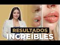 Descubre qu hay detrs del relleno de labios