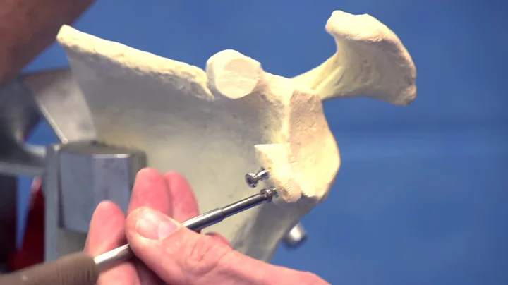 Latarjet Procedure / Shoulder Surgeon Dr David Col...