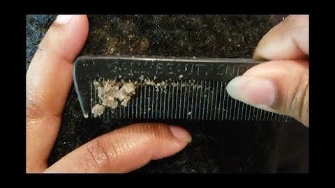 Best of The Itchy Scalp (Dandruff Compilation)