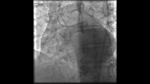 Complex PCI for RCA CTO with bifurcation at distal cap video 1
