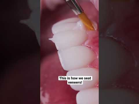 Seating Veneers!😱🦷