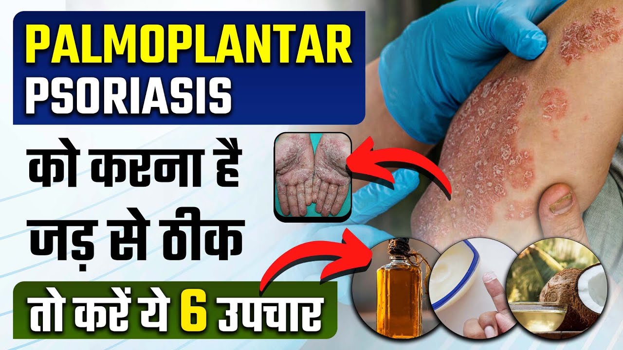 How To Manage Palmoplantar how-to-manage-palmoplantar