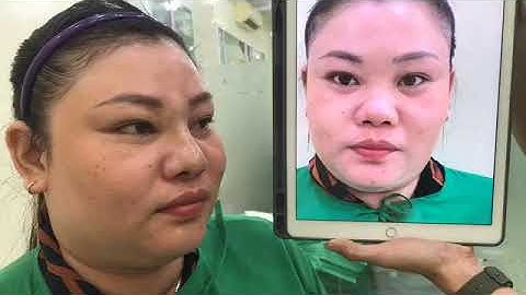 [🔴] LIVESTREAM: KHÁCH HÀNG THỰC HIỆN NÂNG MŨI SỤN SIÊU MỀM