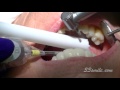 Smile makeover dental procedure at cosmetic dental associates in san antonio tx