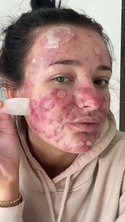 Best Fazit’s Pimple Patch Peels! #acneproneskin #acne #acnepositivity #pimplepopper #pimplepatch
