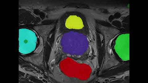 Online interactive segmentation with a generalized MRI model