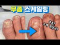 고객님 발톱무좀 스케일링은 쭉 꾸준히 관리하셔야 합니다❗전적으로 스케일링을 믿으셔야 합니다❗