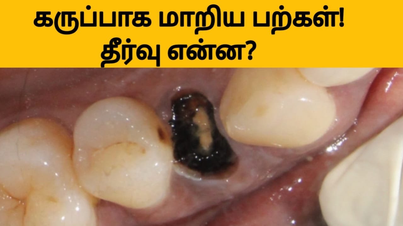 கருமை நிற சொத்தை பற்கள் காரணங்கள்/தீர்வுகள் (Black tooth cavity reasons
