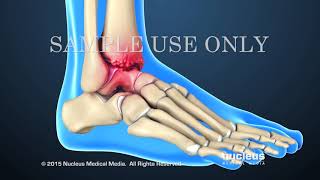 Total Ankle Replacement Surgery  - Nucleus Health