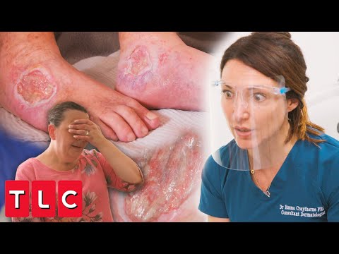 Dr. Emma Treats Exposed Ulcers Caused by Gangrene | Save My Skin