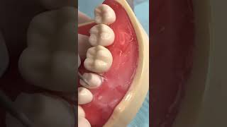 Tooth prep for a lower premolar crown! #dentalshorts #dentalcrowns #dentaleducation