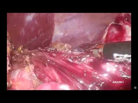 Gastric GIST, Laparoscopic Wedge Resection