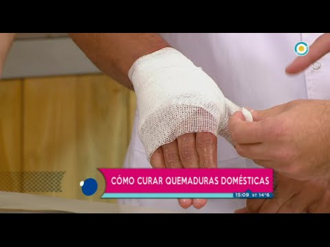 como curar quemaduras de cocina