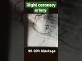 Right coronary artery with 8090 9099 and 100 blockage  angiography shorts