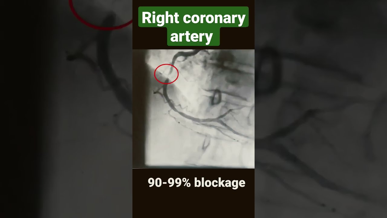 Right Coronary Artery With 80 90 99 And 100 Blockage Angiography Shorts