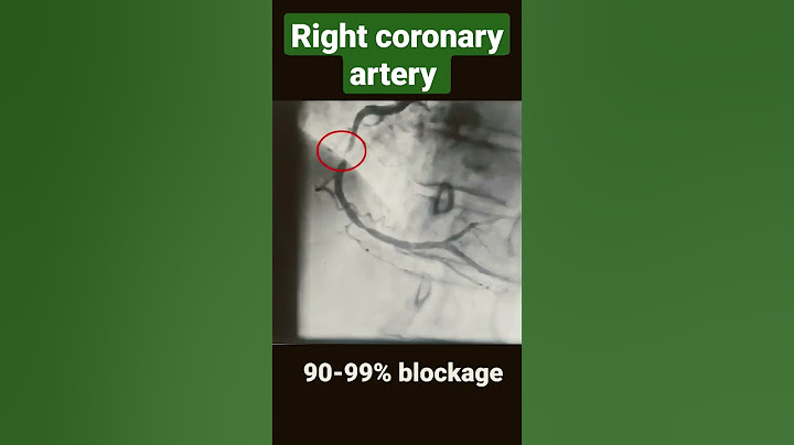 Right coronary artery with 80-90%, 90-99% and 100% blockage ( angiography) #shorts