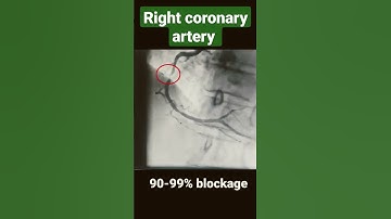Thumbnail of Right coronary artery with 80-90%, 90-99% and 100% blockage ( angiography) #shorts