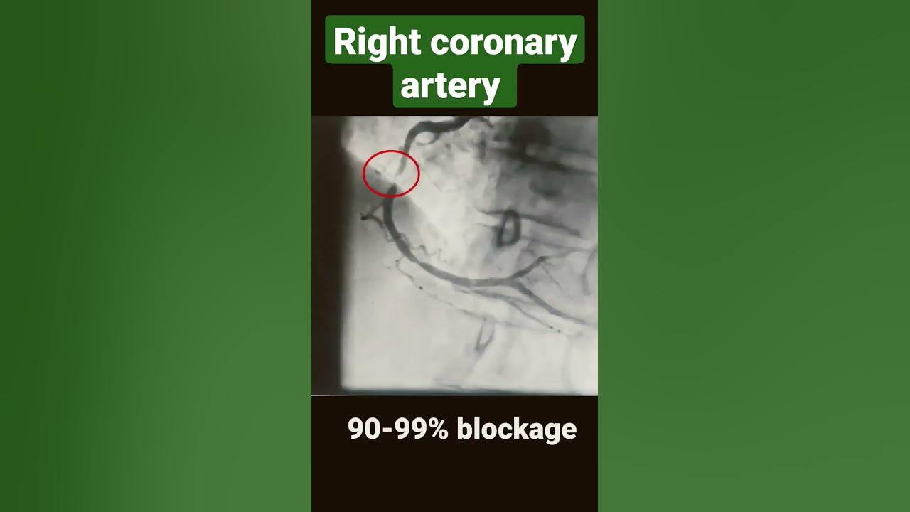 Right coronary artery with 80-90%, 90-99% and 100% blockage ( angiography) #shorts Right coronary artery with 80-90%, 90-99% and 100% blockage ( angiography) #shorts