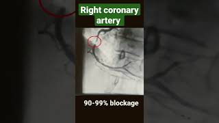 Right coronary artery with 80-90%, 90-99% and 100% blockage ( angiography) #shorts screenshot 3