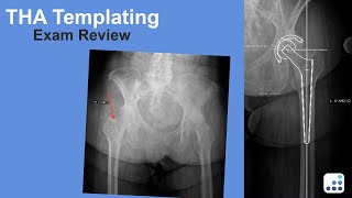 THA Templating Exam Review - William Griffin, MD