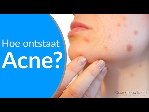 WAT IS ACNE, HOE ONTSTAAT ACNE en hoe kan je acne voorkomen?