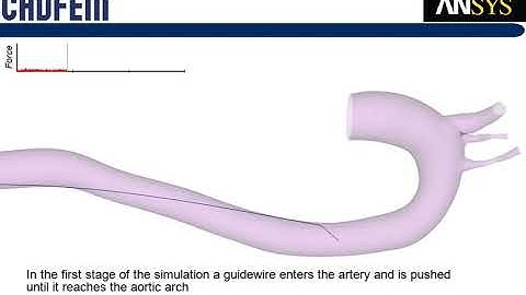 ANSYS in the Medical Device Industry - Catheter Guidewire Insertion