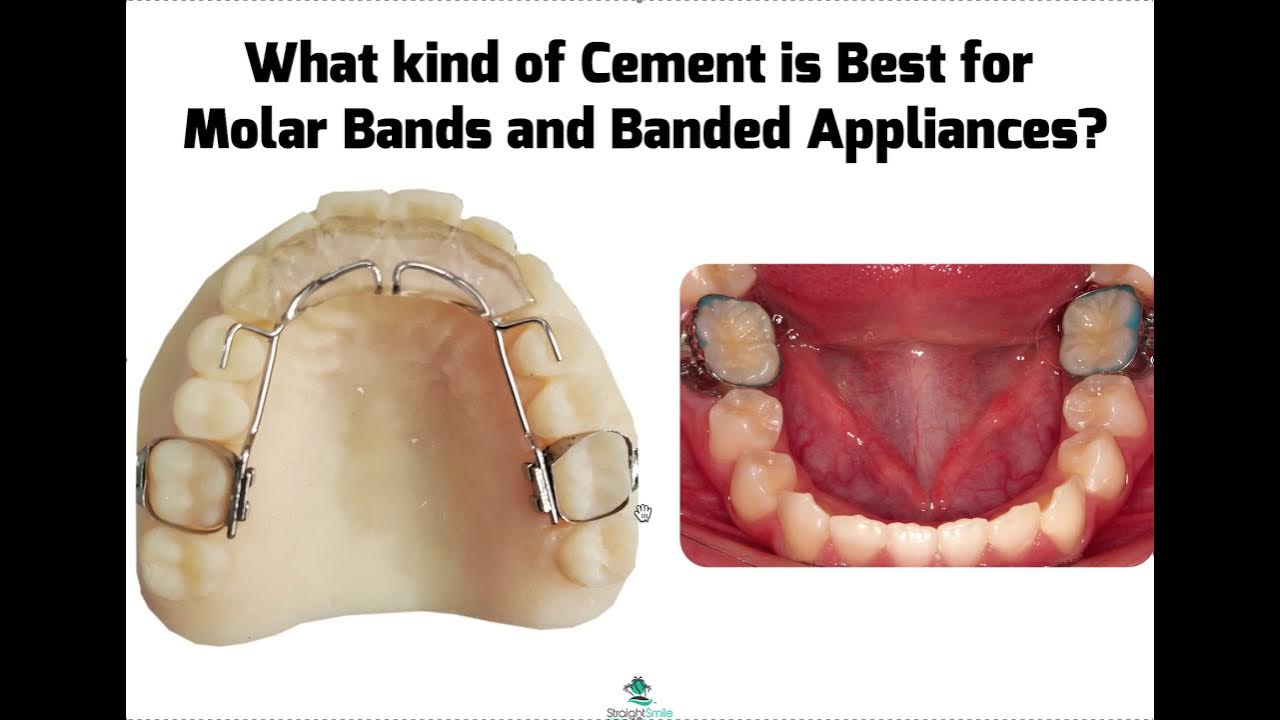 What Kind of Cement is Best for Banding Appliances or Molar Bands YouTube