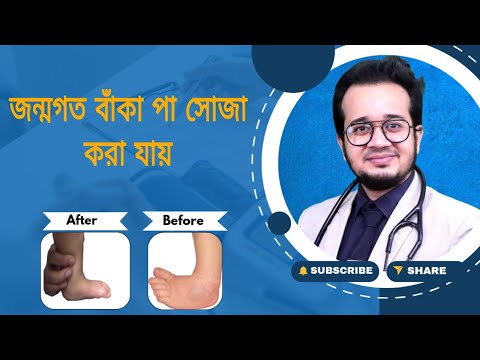 👶 ক্লাব ফুট বাচ্চা এর ফলো আপ।।@DrIftekharAlam  #club_foot #dr_iftekhar #ক্লাব #baby #jointdisease