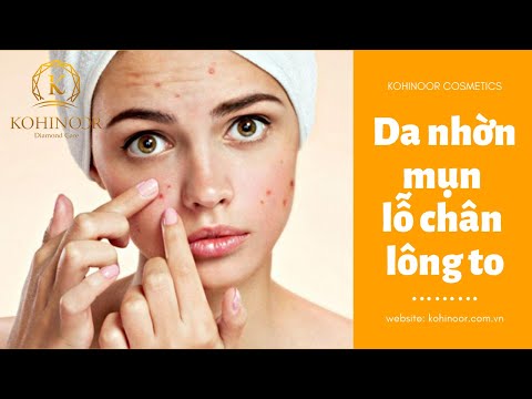 Da nhờn mụn lỗ chân lông to | Da nhờn phải làm thế nào?
