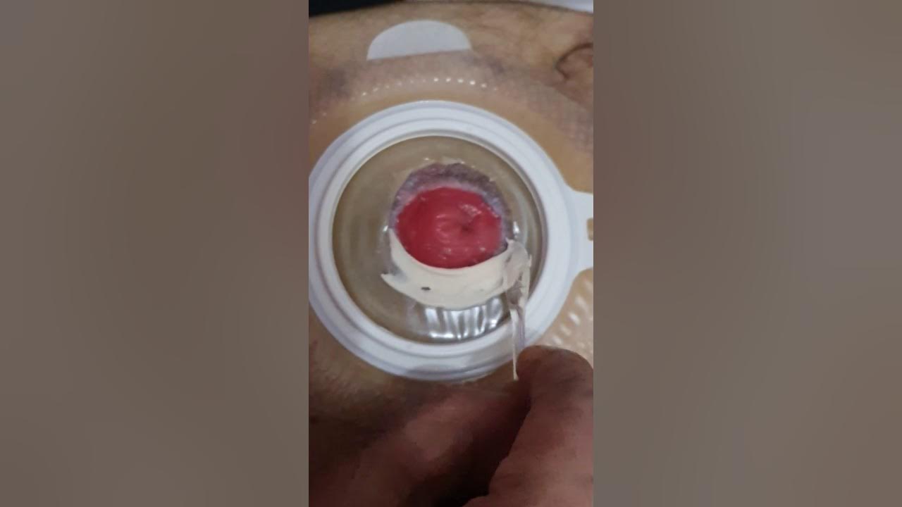 Urinary bladder removal patients home tutorial to connect the stoma bag