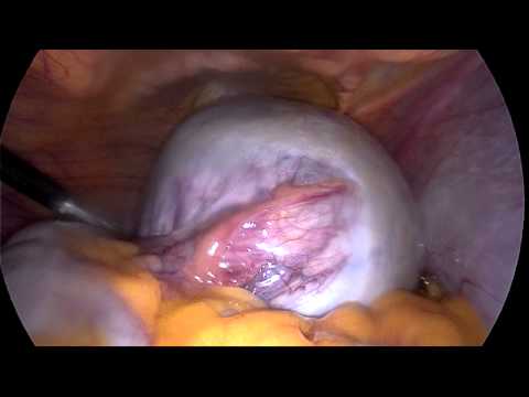 Large Dermoid Cyct Diagnosed By Ultrasound 1