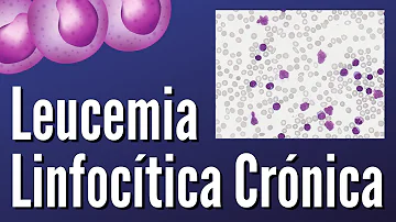 ¿Cuál es el resultado de laboratorio más importante en la leucemia linfocítica crónica?