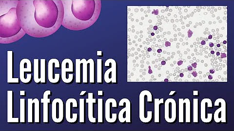 Come si cura leucemia linfatica cronica?