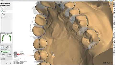 Tooth Segmentation with OrthoAnalyzer 2013