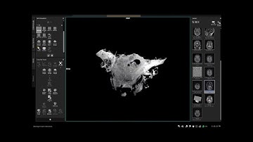 MRI Inner Ear cochlea post Processing in magnetom vida #radiology #mri #mritech #medicalimaging
