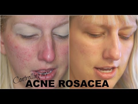 Acne Rosacea Skincare! What Finally Worked? Dermalogica Update #