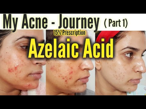 My Acne Journey - Part 1 : Azelaic