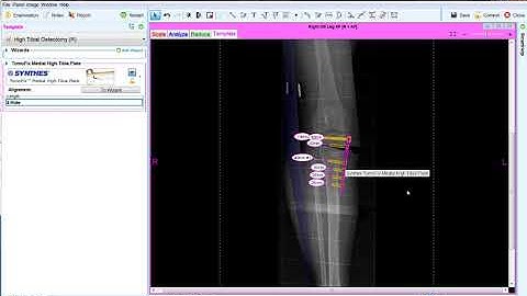 High Tibial Osteotomy | Materialise Medical