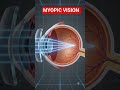 Myopic vision of a person #viral #3danimation #science #shorts #class10 #eyemovements