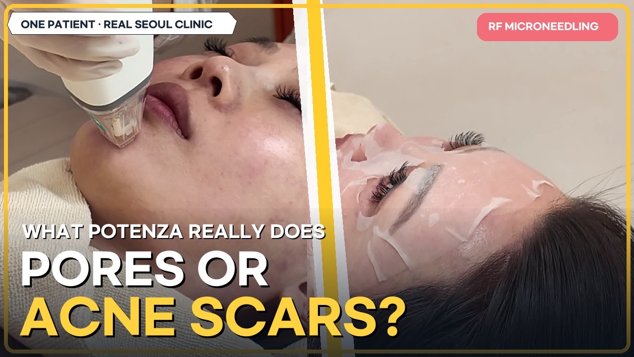 Potenza RF Microneedling: Pores, Acne Scars & Recovery | Korea