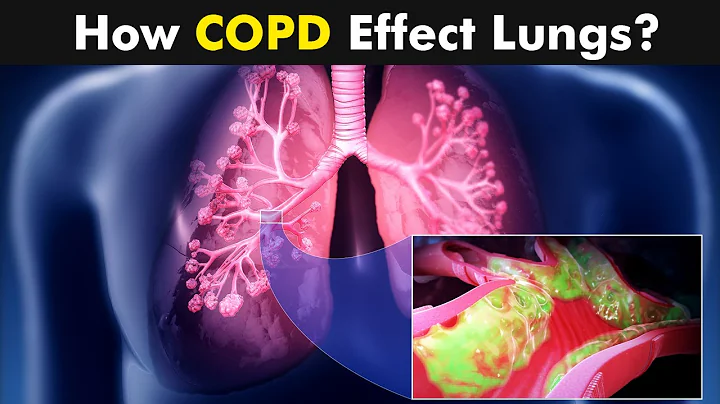 Chronic Obstructive Pulmonary Disease (COPD) | Symptoms, Causes And Treatment (Urdu/Hindi) - DayDayNews