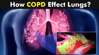 Chronic Obstructive Pulmonary Disease (COPD) | Symptoms, Causes And Treatment (Urdu/Hindi) screenshot 4