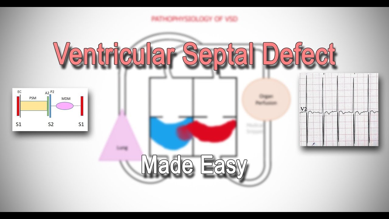 Atrial Septal Defect (ASD): Pathophysiology & Clinical Features - YouTube