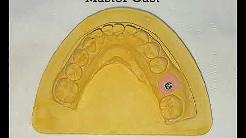 Customization of Impression Coping By Dr  Akash Akinwar MDS Mumbai