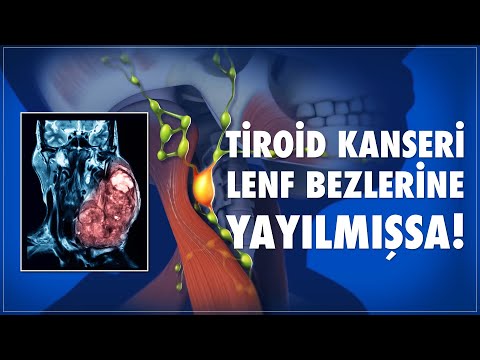 Tiroid Kanseri Lenf Bezlerine Yayılmışsa?