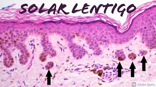 Solar Lentigo (vs Lentigo Maligna Melanoma In Situ on ‪SOX-10‬ Stain): 5-Minute Pathology Pearls screenshot 4